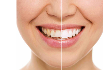 Dr-Ebel-Bruehl-leistungen-Bleaching-B Bleaching, Zahnarztpraxis Ebel und Kollegen